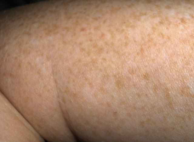 Freckles